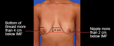 Ideal nipple placement for lollipop lift
