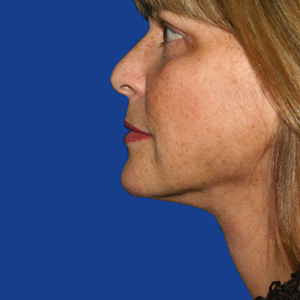 Jowls after neck lift - side view