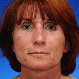 After woman's neck lift - front view