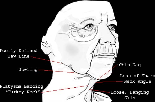 Diagram of aging face and neck