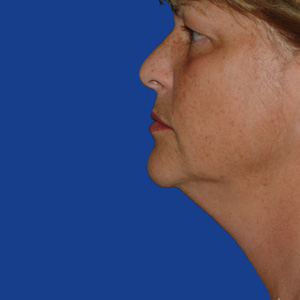 Jowls before neck lift - side view