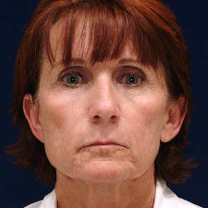 Before woman's neck lift - front view