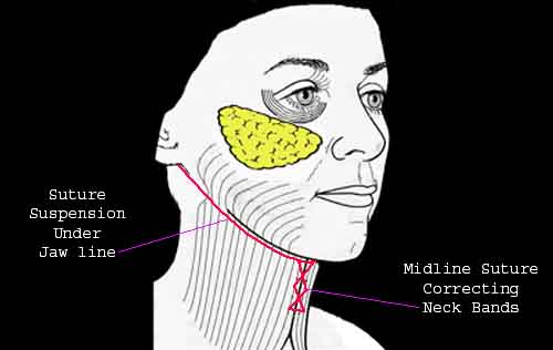 Diagram of neck lift using suture suspension