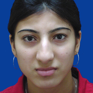 Before rhinoplasty surgery - front view