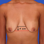 Ideal nipple placement for lollipop breast lift