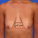 Ideal nipple placement for anchor breast lift