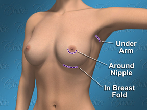 Diagram of common breast incision sites