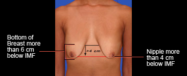 Ideal nipple placement for anchor breast lift