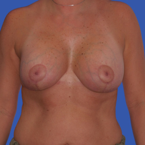 After anchor breast lift for mommmy makeover - front view