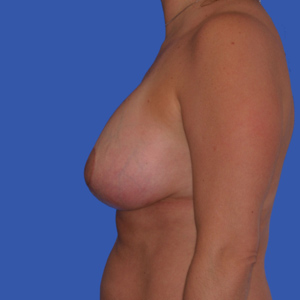 After anchor breast lift for mommy make over - side view