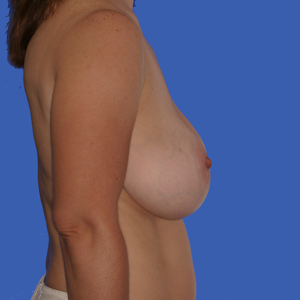 Drooping breasts before mommy make over augmentation - side view