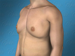 Diagram of male breast roll, symptom of gynecomastia
