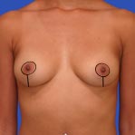 Lollipop breast augmentation incision