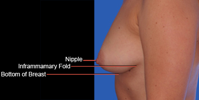 Diagram of nipple placement