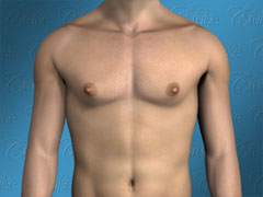 Male chest with puffy nipple gynecomastia - front view