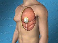 Diagram showing muscles of male chest with puffy nipple gynecomastia