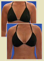 Breast Augmentation with One Fingerbreadth Cleavage