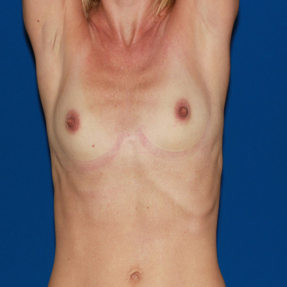 Asymmetric breast folds