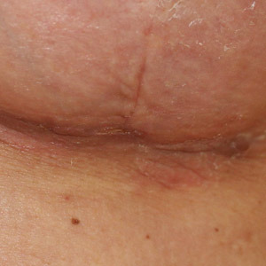 Wound breakdown at T junction of anchor breast lift