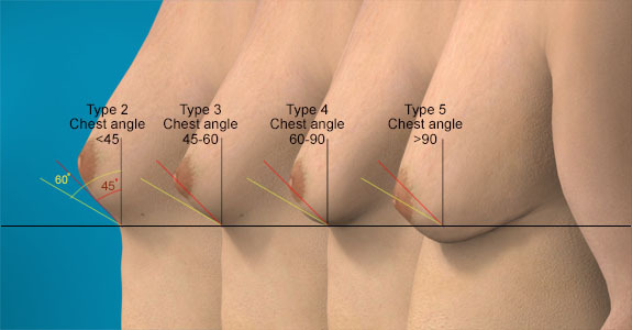 Skin laxity between type 2 and type 5 gynecomastia