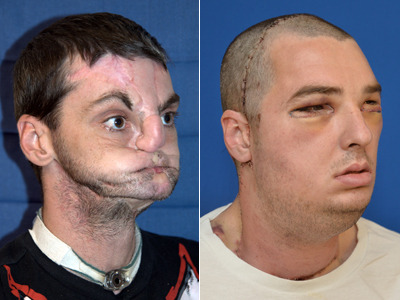 before and after photo of face transplant