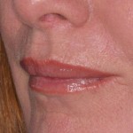 after picture of wrinkles removed from around the mouth