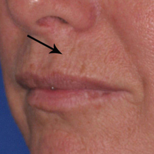 before photo of wrinkles around the mouth