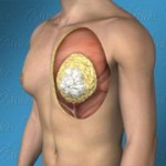 Gynecomastia types classified by Dr. Cruise