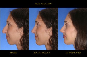 Rhinoplasty before and after picture