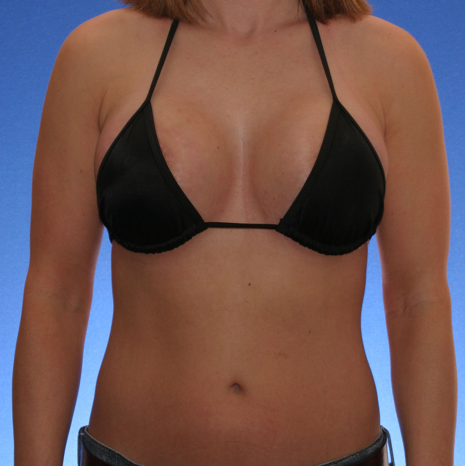 Breast Reduction DD to C Cup Before & After Photos, Newport Beach,  California (CA), Joseph T. Cruise, M.D., Board Certified Plastic Surgeons