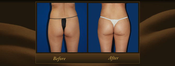 Orange County Brazilian Butt Lift Patients Report Improved Skin Quality
