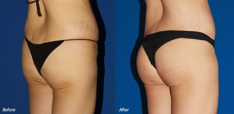 Orange County Brazilian Butt Lift Patients Report Improved Skin Quality