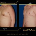 Gynecomastia patient who had free nipple grafting to improve his chest. 