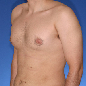 Type 2 Gynecomastia 45 degree chest angle - Orange County Male Breast Reduction from Joseph T Cruise, MD