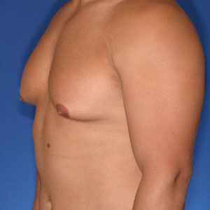 Type 4 Gynecomastia 90 degree chest angle - Orange County Male Breast Reduction from Joseph T Cruise, MD