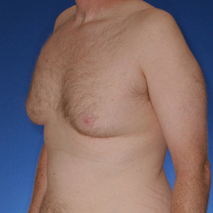 Type 5 Gynecomastia with breast sag - Orange County Male Breast Reduction from Joseph T Cruise, MD