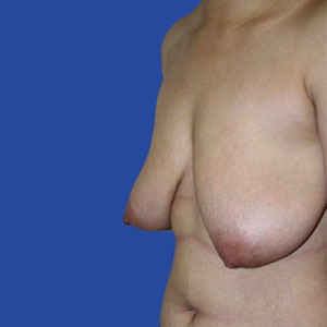 Type 7 gynecomastia - male breast reduction from Orange County plastic surgeon Joseph T Cruise, MD