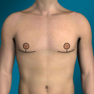 Anchor lift incision for gynecomastia type 4 surgery
