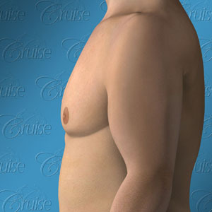 Newport Beach before and after male breast reduction with anchor lift pictures - Gynecomastia Type 5: breast sag