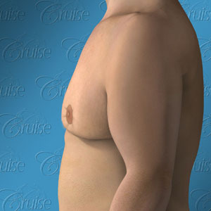 Newport Beach before and after male breast reduction and donut lift pictures - Gynecomastia Type 5: breast sag
