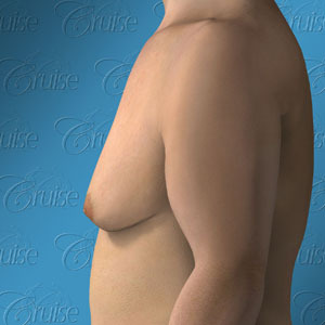 Newport Beach before and after male breast reduction pictures - Gynecomastia Type 5: breast sag