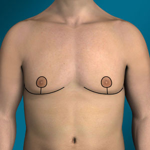 Anchor lift incision for gynecomastia type 5 surgery