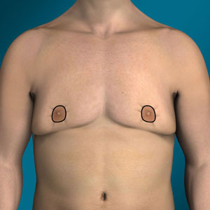 Donut incision for gynecomastia type 5 surgery