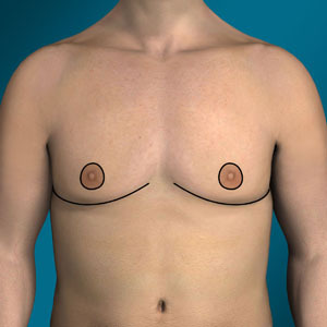 Free nipple graft incisions in gynecomastia type 7 surgery