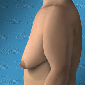 Newport Beach before and after male breast reduction pictures - Gynecomastia Type 7: severe breast sag