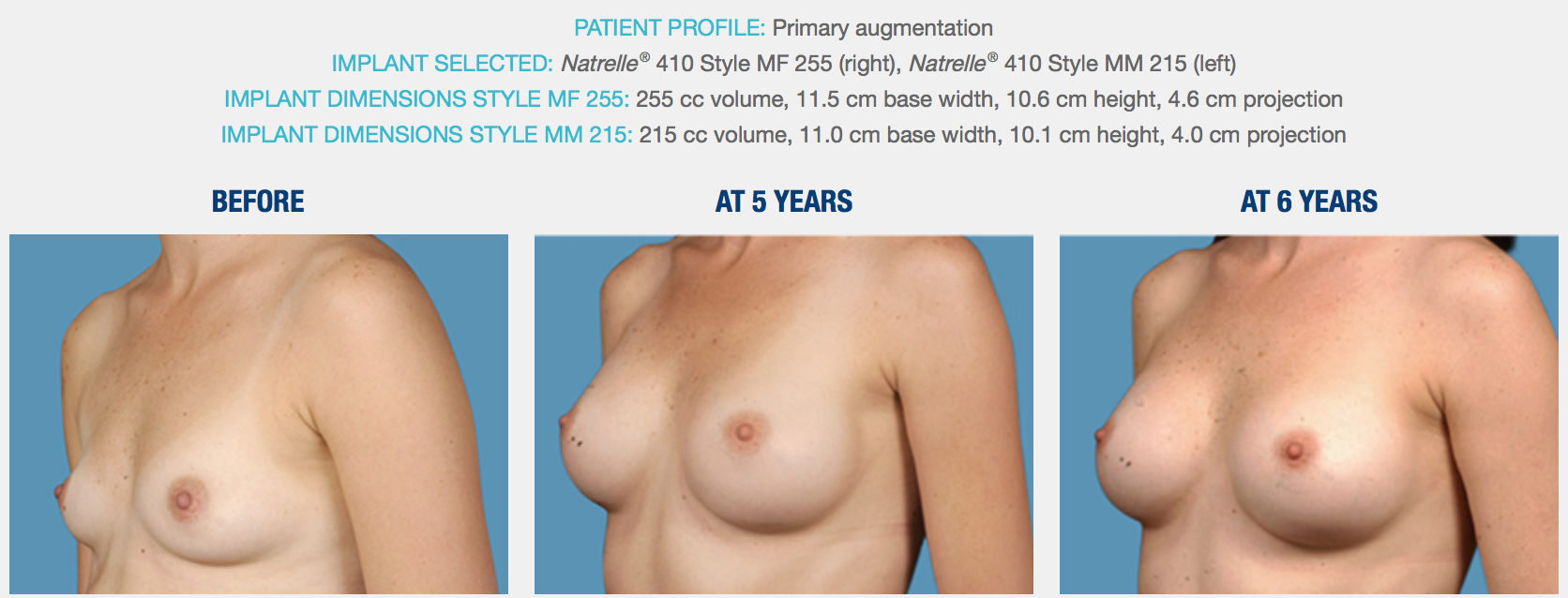 Natural Looking Breast Implants