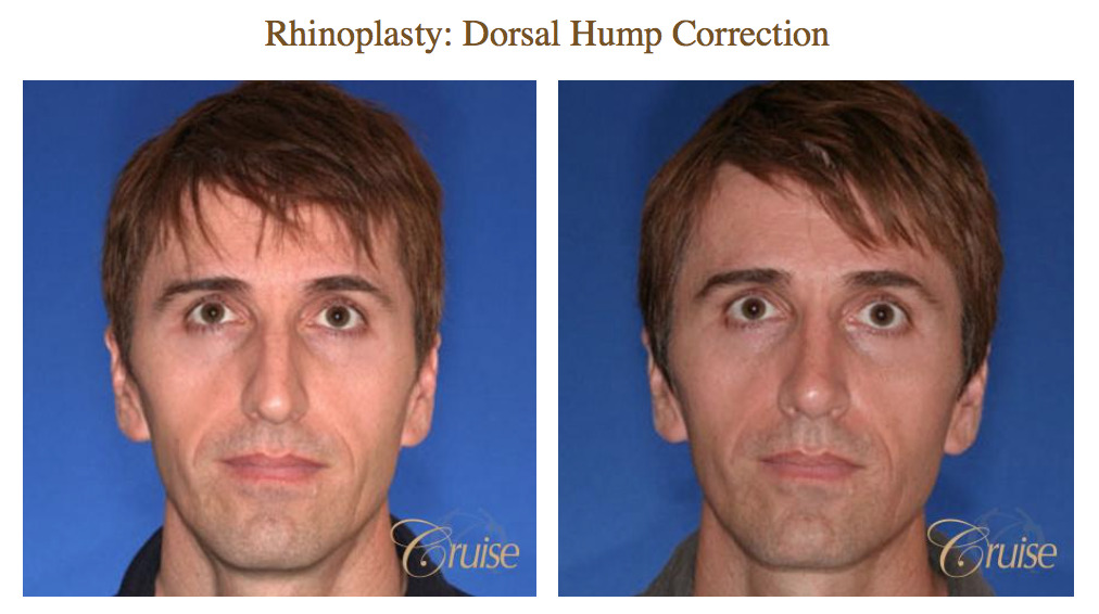 Rhinoplasty Austin