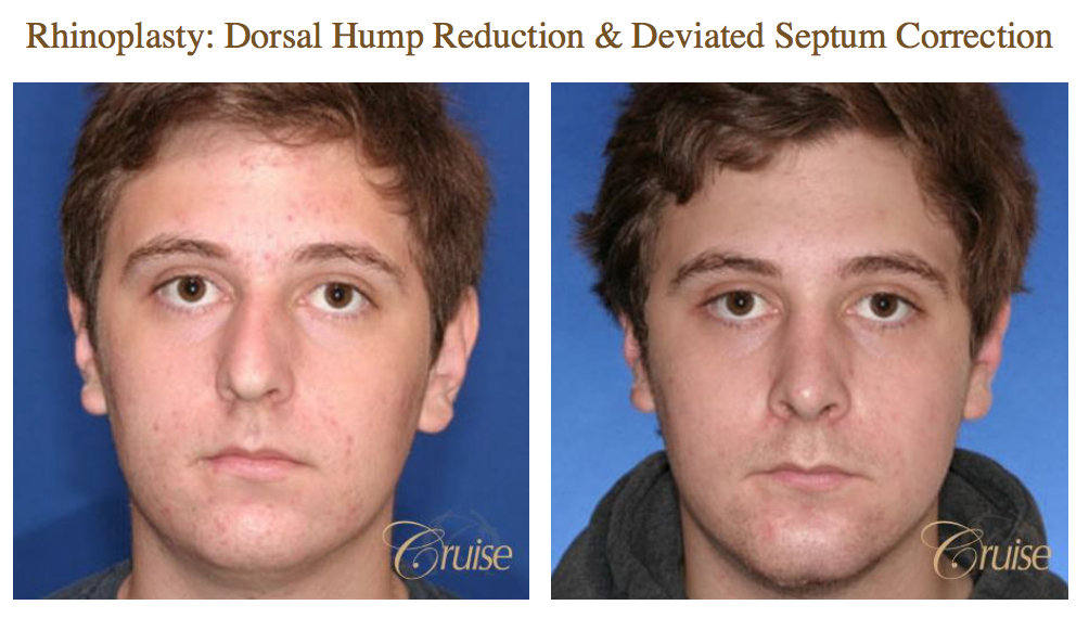 Rhinoplasty Austin Tx