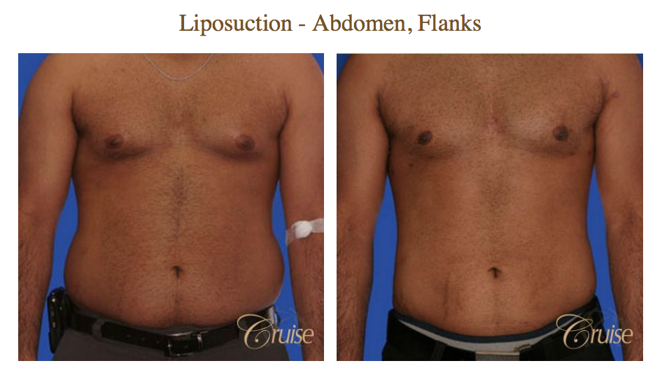 How Much Does Stomach Liposuction Cost in California?