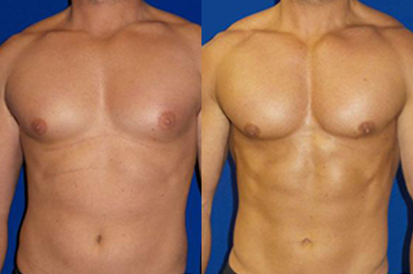 gynecomastia before and after orange county CA